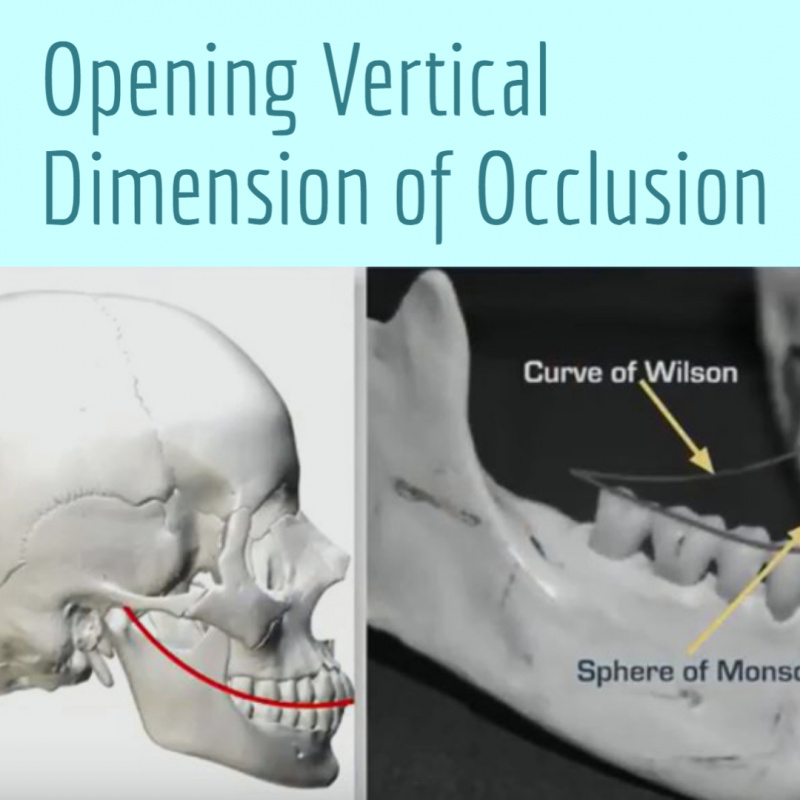 Opening Vertical Dimension Of Occlusion V3186 Occlusion CE Video 