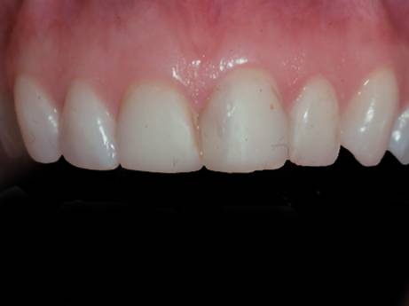 Veneers - Patient Education - Patient Education